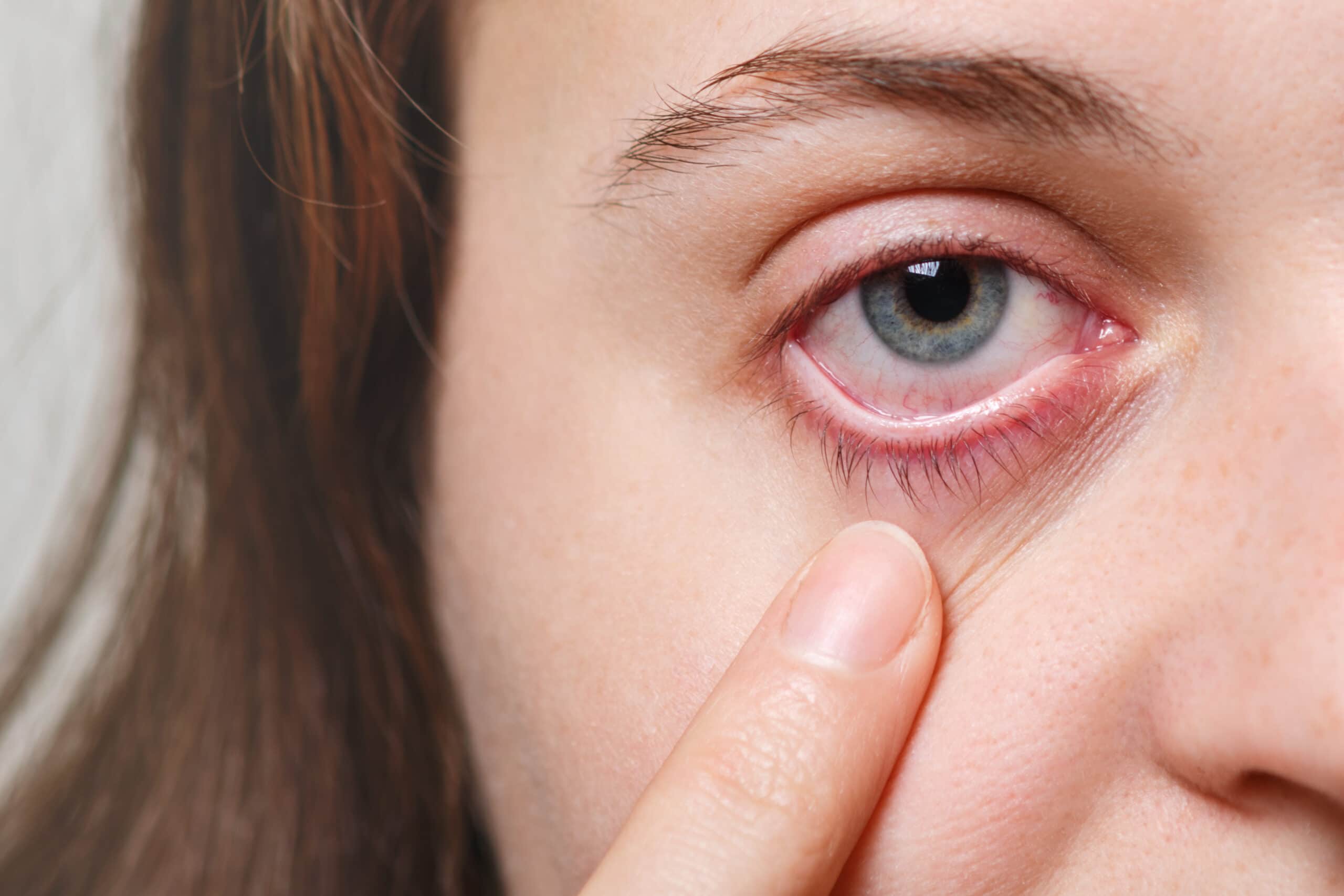 picor de ojos en primavera